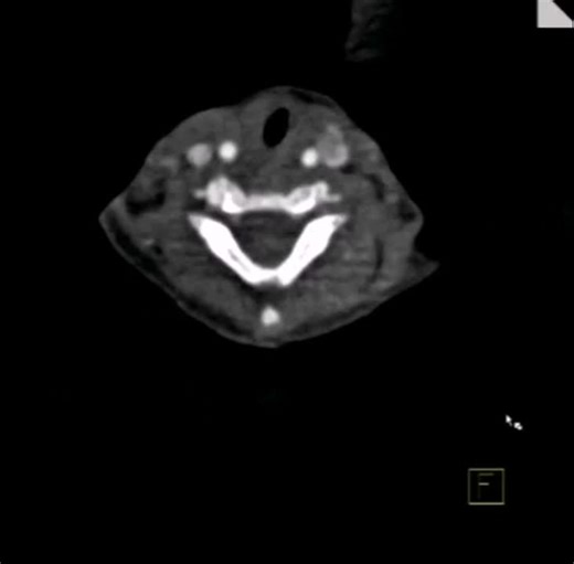 #somatom_definition_flash #radiology #imaging #coronary #cardiac #cta #ct #syngovia #cardiovascularimaging #computedtomography #cardiac #angiography #postprocessing #anatomy #heart | Mohamed Elboraey