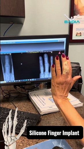 Impressive before and after xrays ! 🫨 Finger Arthritis (PIP Joint)