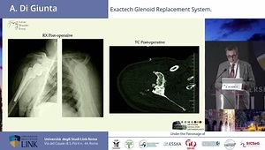 Managing Glenoid Defects in Shoulder Arthroplasty: Planning, Fixation, and Stability