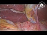 The Anatomy of Rouviere's Sulcus as Seen During Laparoscopic Cholecystectomy • Video • MEDtube.net
