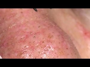 How To Remove Blackheads And Whiteheads On Face Easy #63 ✦ Dr Laelia ✦
