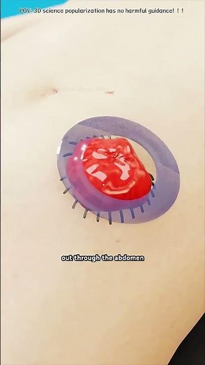 How a Urostomy Works!#urostomy #ostom#bladdercancer #medicalvideo