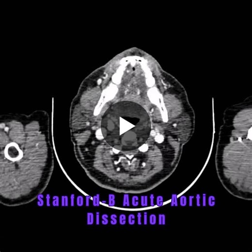 #aace #asteraorticcentre #astercmi #asterhospitals #asterdmhealthcare #typebaorticdissection #tevar #aorticdissection #thoracicaorta #endovascularsurgery #vascularsurgery #cardiacsurgery #aorticteam… | Krishna Chaitanya K H