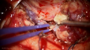 #273: Resection of a Basal Temporal Arteriovenous Malformation with Feeding MCA Aneurysms - About the Surgeon and Procedure - Live Surgery and Chat with Dr. Spetzler