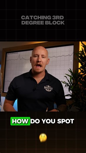 Understanding 3rd Degree AV Block on ECG | Geoff Murphy posted on the topic | LinkedIn