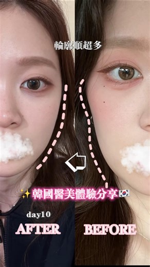 Mandy on Instagram: "韓國醫美體驗分享｜江南站 CP 值超高的醫美初體驗 🇰🇷✨ 📍 地點：沛莉雅皮膚科 @priaclinic.tw @priaclinic (江南站 5 號出口直走) - 戴牙套後陷入「牙套臉」的地獄， 加上運動量跟不上吃的速度，體重不知不覺一直往下掉，臉頰凹陷、嘴邊肉線條變得明顯 越看越不順眼 ಠ_ಠ - 這次跟著小分隊一起到韓國，決定安排一趟 CP 值超高的醫美體驗， 順便好好拯救一下被地心引力跟老化摧殘的臉部線條 - 這次體驗的項目 ➮ 美版超聲刀 300 發 ➮ 黃金微針 - 結論： 臉頰沒肉、又很在意拉提效果的人，超聲刀真的非常有感。 直接選美版超聲刀(╯‵□′)╯︵┻━┻ - 診所提供 中、英、日、韓文 溝通，完全不用擔心語言問題。 - 現場也準備了卸妝產品、保養品、美髮用具和茶水，整個流程非常完整，對第一次來韓國做醫美的人來說相當友善。 - 從諮詢到實際施作結束，整體過程都很舒適、節奏也不會讓人有壓力。 工作人員、諮詢師以及施作的醫師都非常專業，講話溫柔又細心，會不斷確認你的狀況！ - 📲預約方式 可以直接透過 LINE 預