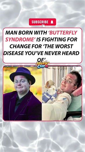 Man Born With “Butterfly Syndrome” Is Fighting for Change: The Worst Disease ever #inspiration
