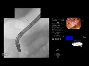 GastroLearning Express: ERCP Tips for Removing Proximally Migrated Biliary Stents