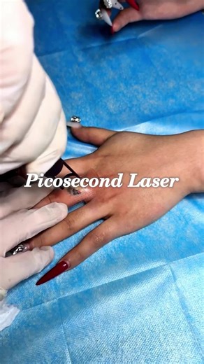 Testing picosecond laser on a dark tattoo today 💥 Watch how fast the ink reacts—so satisfying to see. Do you know why picosecond works faster than others? #tattooremoval #beautydevice #laserclinic #beautytech #trending