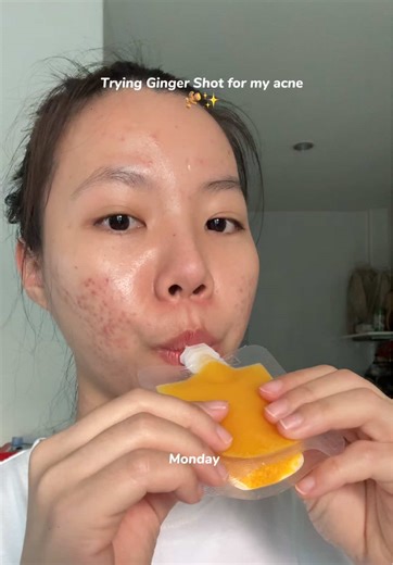 Effective Remedies for Clear Skin and Acne Control