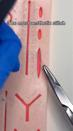 medical_animation on Instagram: "Subcuticular stitch - a quick, smooth closure technique every surgeon should master."