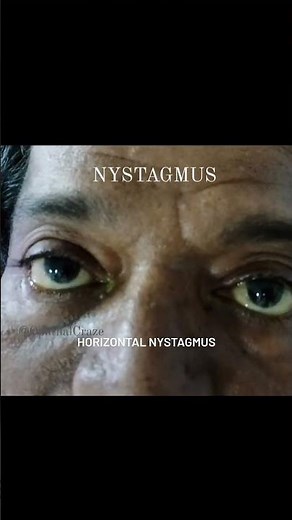 NYSTAGMUS / HORIZONTAL NYSTAGMUS #eye #ophthalmology