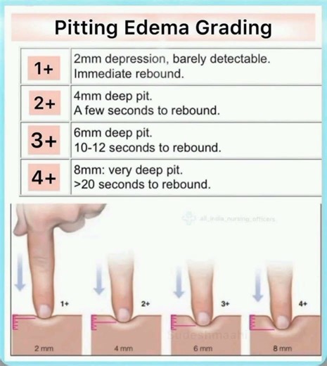 Pitting Edema Grading... #narayannursingclass #medical #edema