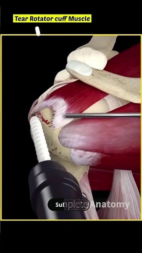 Shoulder Fracture Injury | Rotator cuff Tear Repair | 3D Animation #shorts