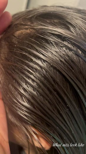 Identifying Nits: A Visual Guide | Lice Treatment Tips