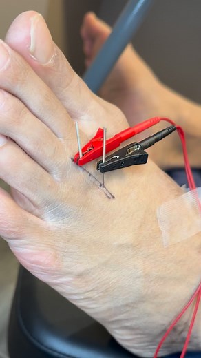 2.3K views · 4.2K reactions |  Dry needling uses a thin needle to target trigger points and release stubborn muscle tension. It’s ideal for chronic pain, nerve irritation, and mobility issues that stretching just won’t fix. Feel the relief and reset your body naturally. #DryNeedling #MuscleRecovery #TriggerPointRelief #ChiropracticCare #SportsPerformance #drkyleross | Chicago Sports Chiropractors | Facebook