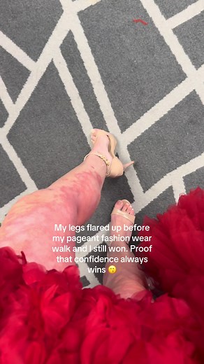 Eczema Flare-Up at Pageant: How I Won Fashion Wear Despite Flared Legs