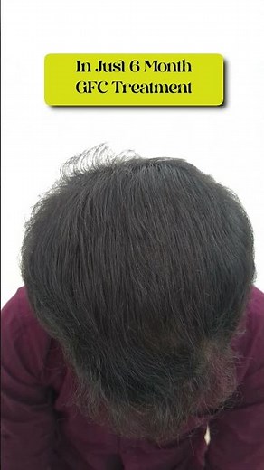 GFC Hair Treatment Results 6 Months — Shocking Growth! 🤯🔥