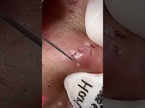 Skincare | Blackheads Removal #799 #tweezers skincare #blackheads blackheads
