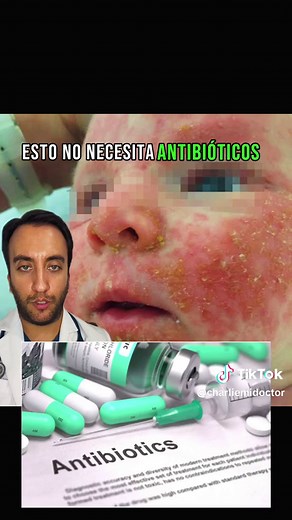 Dermatitis Seborreica en Bebés: Causas y Soluciones
