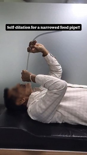 Dr. Pradip Vekariya || Gastroenterologist on Instagram: "For those with esophageal strictures (narrowed food pipe), repeated endoscopic dilations can be costly and uncomfortable. Self-dilation, taught under medical guidance, empowers patients to manage their condition safely at home — reducing hospital visits and treatment costs. This video aims to raise awareness about this simple yet effective technique in public health. Always consult your doctor before starting. #EsophagusHealth #SelfDilatio
