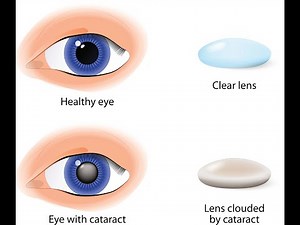 Cataract surgery CPT codes - simplify medical coding