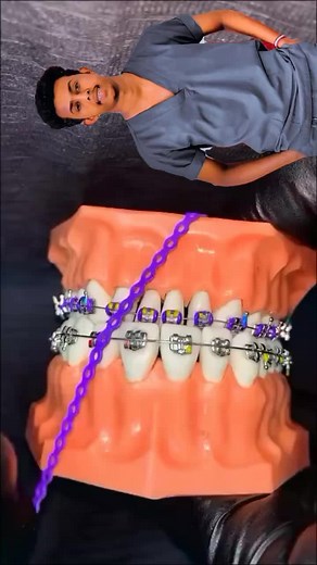 Understanding Dental Braces: Close-up Look at Adjustments