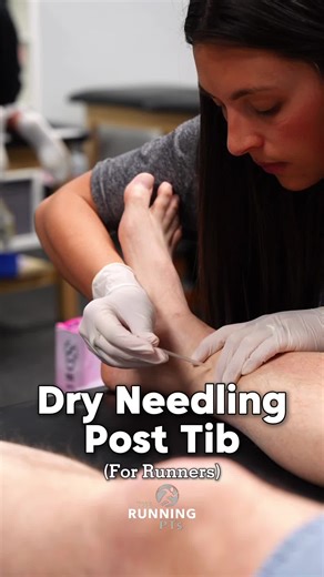 Medial ankle or arch pain from running? Dry needling can help reduce posterior tibialis tightness and support better movement for runners. Follow for runner rehab & performance. The following information is not meant to be instructional nor is it medical advice. Always consult with a physician or doctor of physical therapy before beginning an exercise program.
