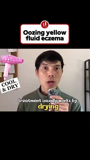 Oozing Yellow Fluid Eczema — What It Means