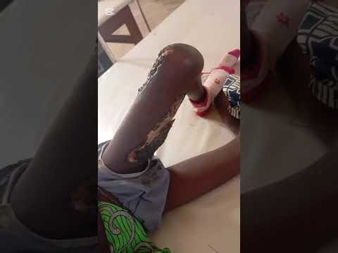 Details in what you need to know about necrotizing fascitis