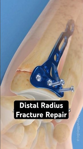 Mending a broken wrist with plate and screws (3D Animation)