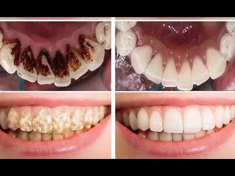 Get Rid of Smoking stains and Tobacco stains from Teeth FAST.