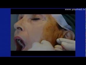 TMJ DISORDERS - hyaluronic acid injection - Part1