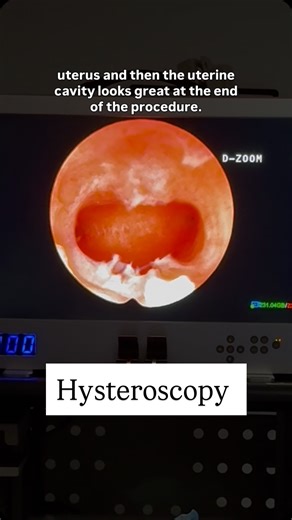 Natalie Crawford MD, Fertility on Instagram: "A hysteroscopy is a minimally invasive procedure that allows your doctor to look directly inside the uterus using a thin, lighted camera. It’s often recommended when you’re experiencing: -Heavy or irregular bleeding -Spotting -Suspected fibroids or polyps -Recurrent miscarriages -Unexplained infertility -Possible scar tissue (Asherman’s syndrome) -Or just when something feels off and answers aren’t showing up on imaging alone The beauty of a hysteros