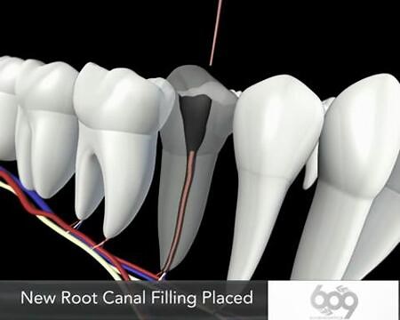 What Happens During Root Canal? Watch This Demonstration to Find Out