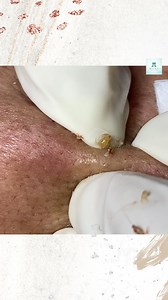 #Trimunhieuqua #spa_uy_tín #Hana_Spa #HANASPA #trimunantoan #Munviem #acnetreatment #blackheadtreatment #blackheadsremover | Hana - Spa and clinic Gò Vấp