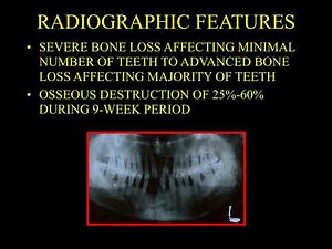 Topic: Aggressive Periodontitis For Final Year BDS