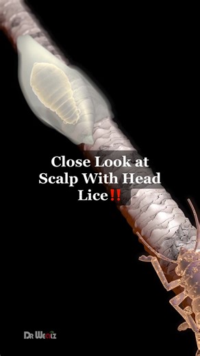 A Scalp Full of Head Lice #animation #lice #headlice #hair #scalp