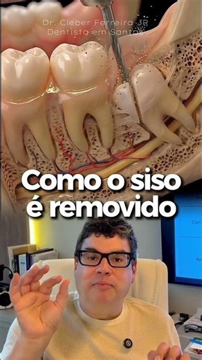 Dente do Siso