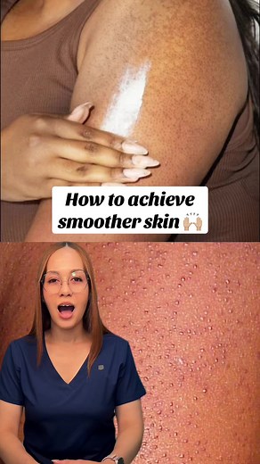 Effective Treatments for Keratosis Pilaris Management