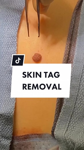 Effective Skin Tag Removal Techniques