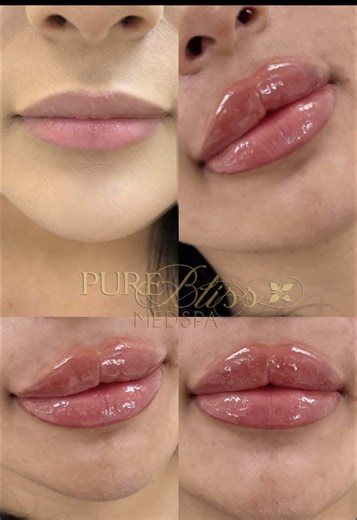 Juicy Lips Enhancements That Maintain Natural Shape