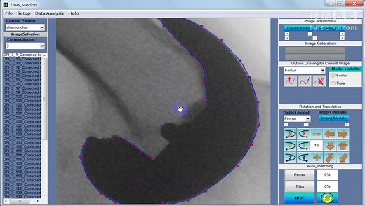 双平面荧光配准系统-Fluo_motion膝关节置换运动功能评估