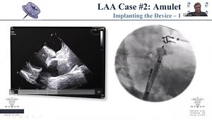 4D ICE for LAAC: Can We Avoid Intraprocedural TEE? What Is the ICE Catheter Workflow?