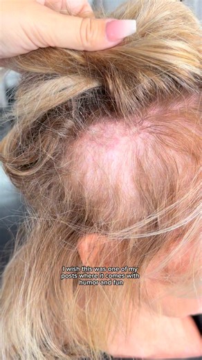 217K views · 2.8K reactions |  Tension Alopecia Awareness  This...