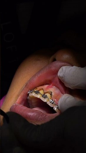 Gingivectomy Treatment Process