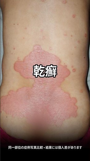 乾癬 症例写真（同一部位）治療前後比較｜ソウル｜お問い合わせGKMC