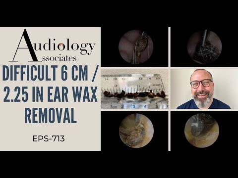 DIFFICULT 6 CM /2.25 IN EAR WAX REMOVAL - EP713