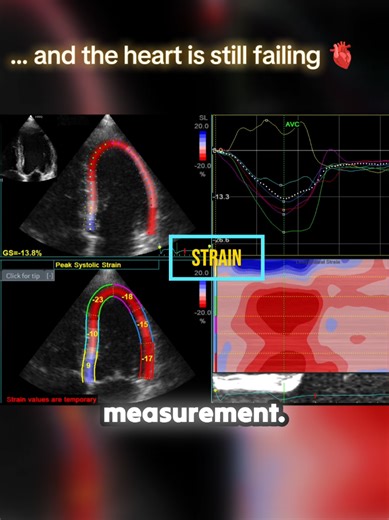 Understanding EF and Heart Failure in Echocardiography