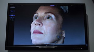 Benefits of Using a Vectra 3D Camera Before Surgery